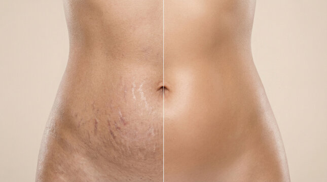 Before and After Stretch Mark Removal Treatment on Female Abdomen Skin