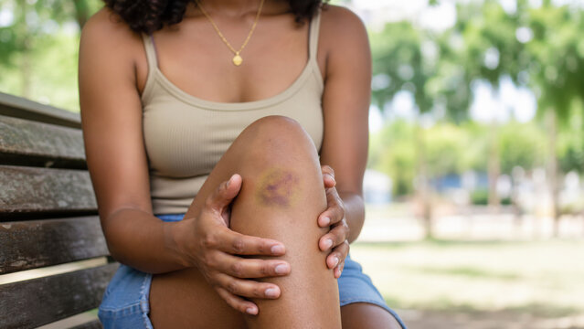 Woman sitting on wooden park bench holding her bruised knee with visible skin generated using ai
