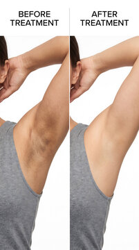 Before and after comparison of arm skin treatment results showing significant improvement