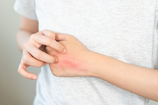 Dermatology asian young woman allergy, allergic reaction from atopic, insect bite, scratching itchy back of hand, red spot or rash of skin. Healthcare treatment of beauty. Isolated on white background