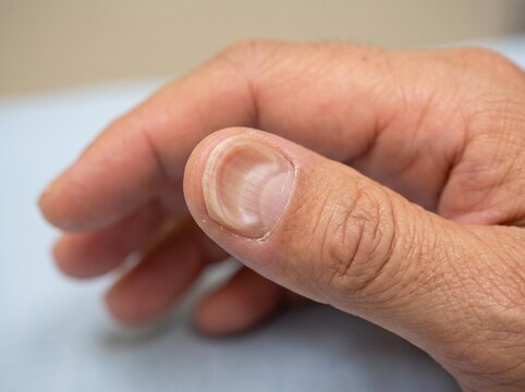 Spoon-shaped nail (Koilonychia) &mdash; Clinical Appearance of Iron Deficiency