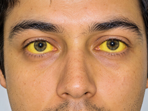 Scleral icterus and skin manifestation of jaundice