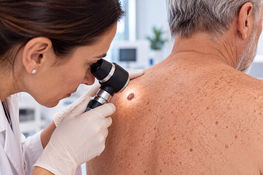 Dermatologist Examining a Mole on a Senior Man's Back with a Dermatoscope Dermat&oacute;loga examinando un lunar en la espalda de un hombre mayor con dermatoscopio
