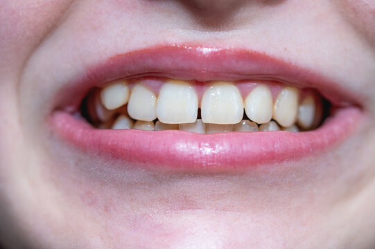 Close-up of a female smile showing teeth with a gap and mild crowding before orthodontic treatment. Detailed macro shot of human mouth, yellowed teeth, diastema, and dental alignment issues for stomat