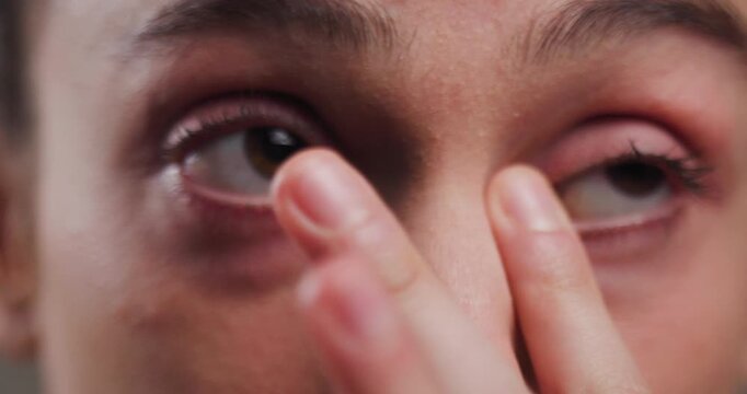 Close-up of a person gently touching their bruised eye, depicting pain and injury