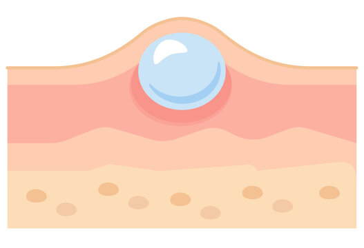 Cross-section diagram of skin showing a blister or vesicle formation.