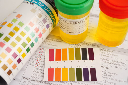 Urinalysis, urine cup with reagent strip pH paper test and comparison chart in laboratory.
