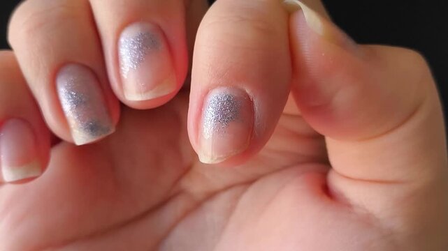 Close up of broken fingernails, illustrating damaged nails, an untidy manicure and poor nail care.