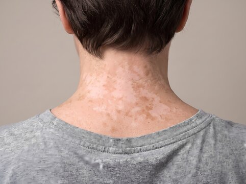 Close-up view of a person showing symptoms of vitiligo depigmentation on the back of their neck and skin surface