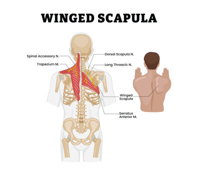 Winged Scapula Muscle Anatomy labeled diagram, educational musculoskeletal poster design healthcare, scapular nerve involvement. Spinal Accessory Nerve, Dorsal Scapular Nerve, Long Thoracic Trapezius