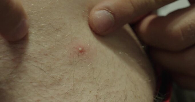 Close-up of an inflamed pimple with a visible whitehead on hairy skin, representing acne and skin irritation.