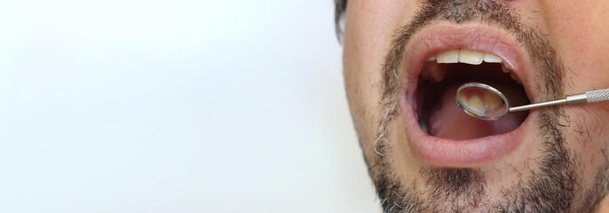 Professional examination of the condition of teeth using a dental mirror. Checking the health of the oral cavity with a dentist's mirror. Close-up of a man with an open mouth, his teeth, crooked teeth © Mariia
