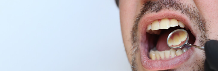 Professional examination of the condition of teeth using a dental mirror. Checking the health of the oral cavity with a dentist's mirror. Close-up of a man with an open mouth, his teeth, crooked teeth © Mariia