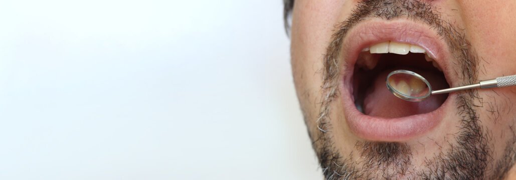 Professional examination of the condition of teeth using a dental mirror. Checking the health of the oral cavity with a dentist's mirror. Close-up of a man with an open mouth, his teeth, crooked teeth