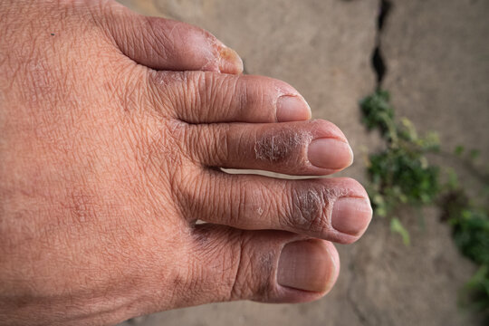 The skin across the knuckles and dorsal surface of the toes appears thick, dry, wrinkled, and hyperpigmented with flaky, whitish scales