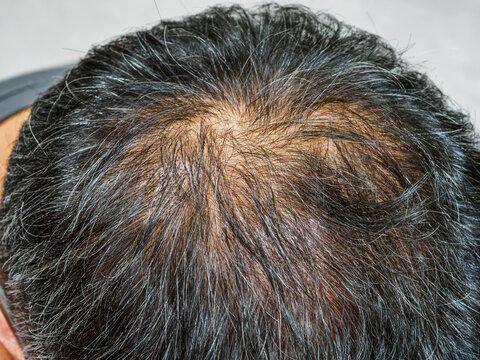 薄毛で頭皮が見えている男性の頭①