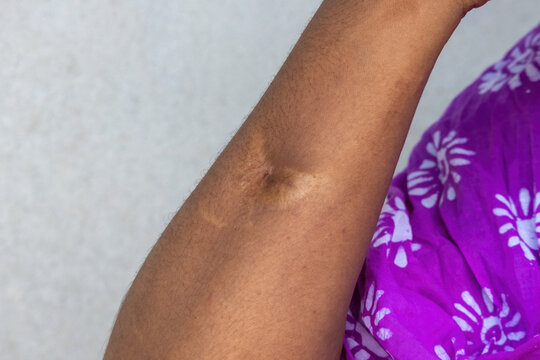 Close-up view of a scar mark on female arm skin showing tissue healing from injury or burn injury outdoors.