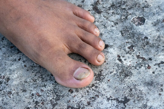 Woman foot displaying discolored and damaged big toenail condition outdoors. Fungal nail infection and dermatology healthcare view.