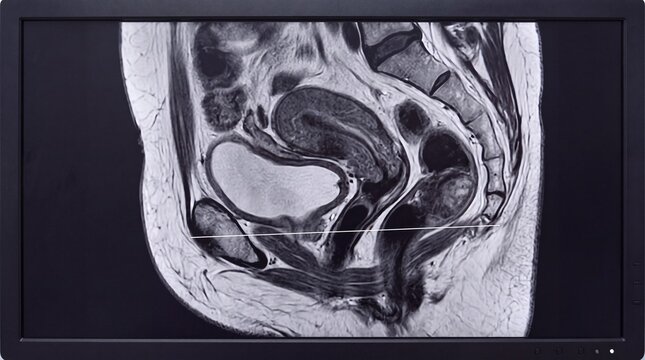 Sagittal Pelvic MRI Showing Female Pelvic Organs and Anatomy