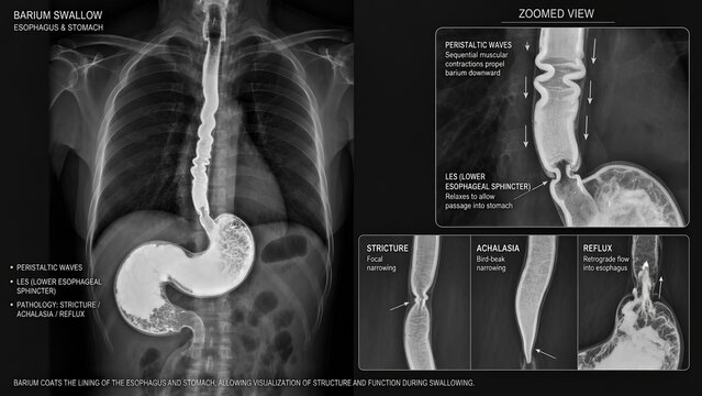 Barium swallow x-ray visualizing the esophagus and stomach highlighted with contrast media accompanied by a zoomed inset displaying peristaltic waves, lower esophageal sphincter, and strictures