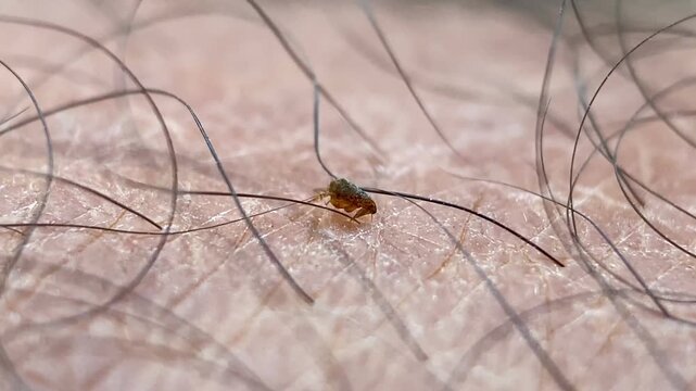 Flea Biting Human Skin and Feeding on Blood