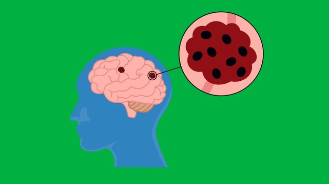 Medical vector animation displaying a human head profile with brain anatomy and a magnified focal tissue necrosis lesion, highlighting brain stem death, cerebral ischemia, stroke, anoxic brain injury
