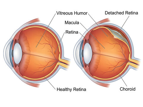 Healthy and detached retina comparison in human eye isolated on white background