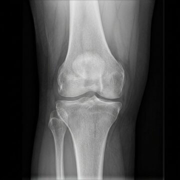Knee X ray Frontal view of a healthy human knee joint showing femur tibia and fibula bones and joint space
