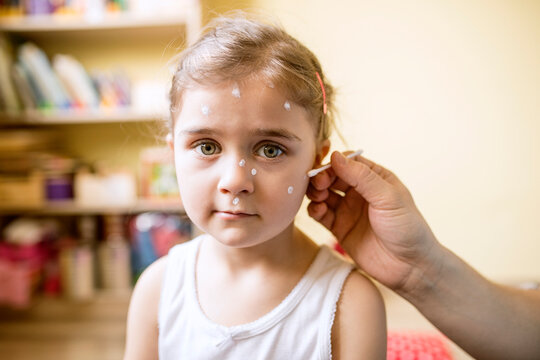 Portrait of girl having chickenpox