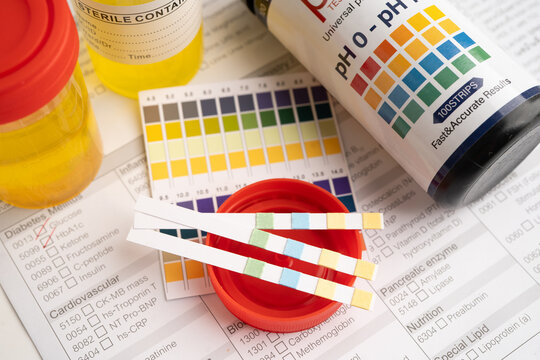 Urinalysis, urine cup with reagent strip pH paper test and comparison chart in laboratory.