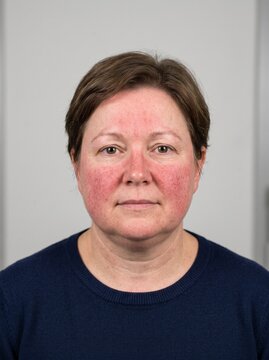 Facial Plethora and Fullness in Cushing Syndrome