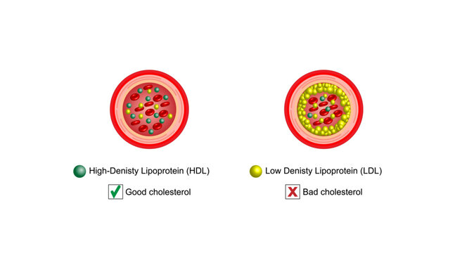 Hyperlipidemia. Atherosclerosis. Types of cholesterol, High-Density Lipoprotein (HDL) and Low-Density Lipoprotein (LDL). Good and Bad cholesterol. Vector illustration.