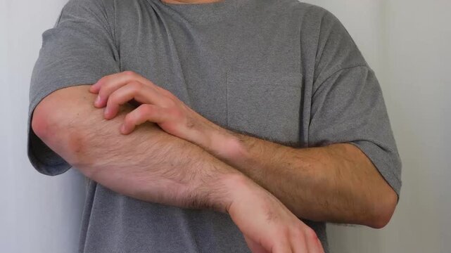 A man is scratching his arms. Standing against a white background, he is scratching his arms; insect bites have irritated his skin, causing it to itch.