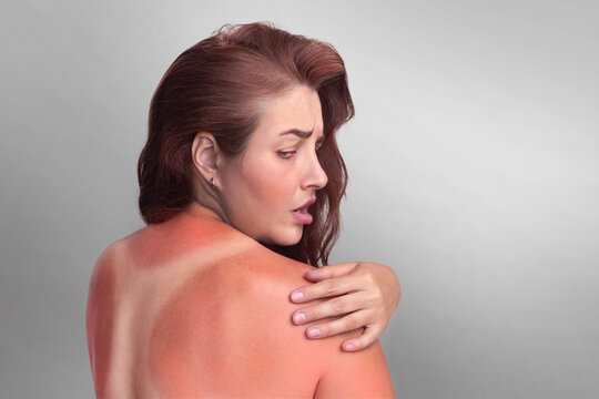 woman with red skin burnt in the sun on her back. Swimsuit skin marks. Woman touches red sunburned back. Close up