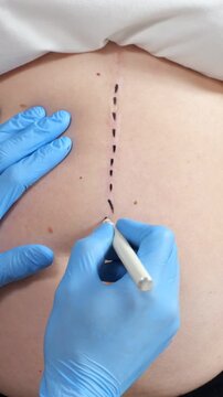 Doctor Wearing Sterile Nitrile Gloves Draws Surgical Incision Line Along Stomach Of Patient. Healthcare Professional Performs Pre Op Belly Marking For Tummy Tuck Procedure With Precision.