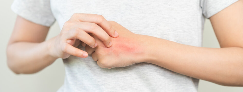 Dermatology asian young woman allergy, allergic reaction from atopic, insect bite, scratching itchy back of hand, red spot or rash of skin. Healthcare treatment of beauty. Isolated on white background