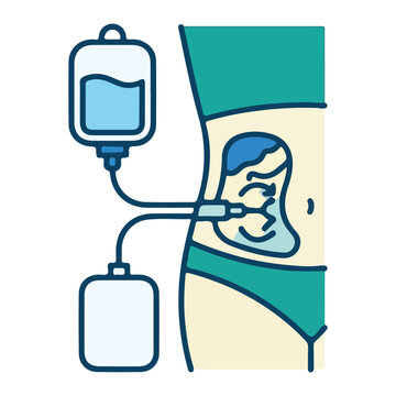 Peritoneal dialysis medical treatment showing kidney therapy with fluid bags