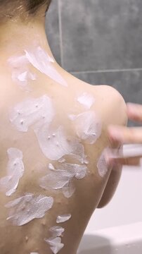 Applying soothing ointment to a 6-year-old boy with chickenpox