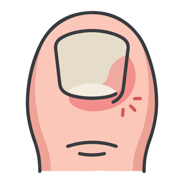 Medical ingrown toenail paronychia infection with painful red toe inflammation