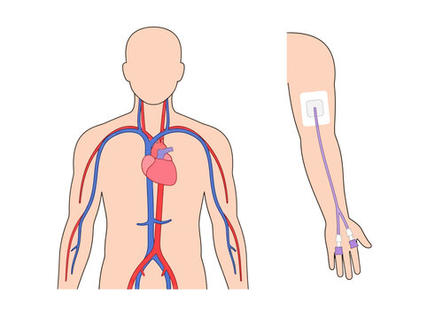 PICC Line Insertion Medical Diagram Showing Venous Access to Heart and Circulatory System with Peripherally Inserted Central Catheter on Arm and Body Anatomy