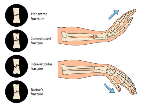 Medical Illustration of Distal Radius Wrist Fractures: Transverse, Comminuted, Intra-articular, and Barton's Bone Breaks