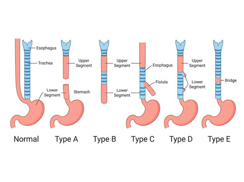 Medical Illustration of Esophageal Atresia and Tracheoesophageal Fistula Classifications, Showing Normal Anatomy and Types A to E
