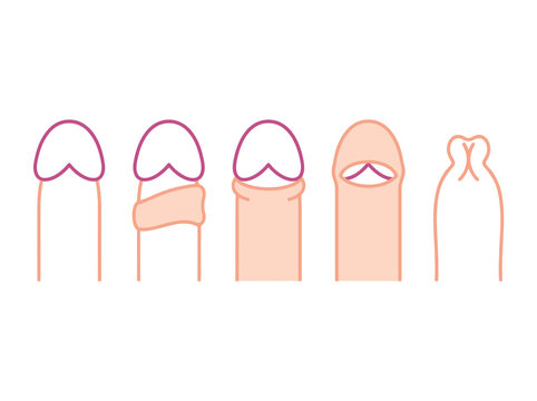Male Circumcision and Foreskin Conditions Medical Illustration - Phimosis and Paraphimosis Diagram
