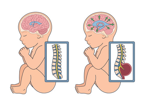Spina Bifida and Hydrocephalus Medical Illustration Comparing Healthy Infant Anatomy with Neural Tube Defects