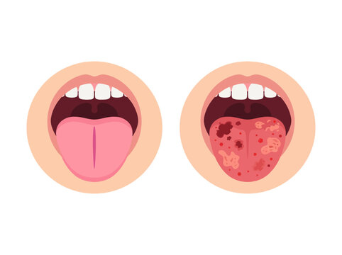 Healthy vs Unhealthy Human Tongue Illustration Showing Spots, Sores and Oral Disease Comparison