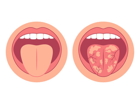 Healthy vs Unhealthy Tongue Comparison Illustration: Oral Thrush, Geographic Tongue, and Dental Hygiene Diagram
