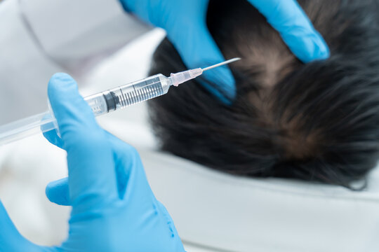 Specialist of hair injection hair tonic for Asian man, damaged hair, hair loss, thinning problem, vitamin deficiency, baldness, postpartum, biotin, zinc, endocrine disorders, hormonal imbalance