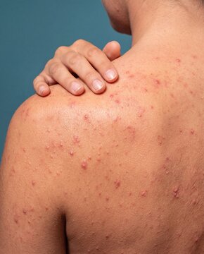 Man with severe back acne and inflamed pimples on shoulders touching irritated skin