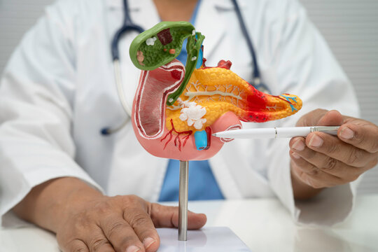 Pancreatitis, pancreatic cancer, Asian doctor with pancreas, gallbladder and bile duct human anatomy model at hospital.