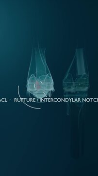 Vertical video: Animating clear left-knee on teal arc drawing causing red pulse marking ACL tear